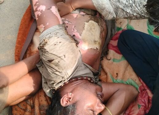 घरेलू लाइट बनाते समय युवक झुलसा हालत गम्भीर अस्पताल में भर्ती।
